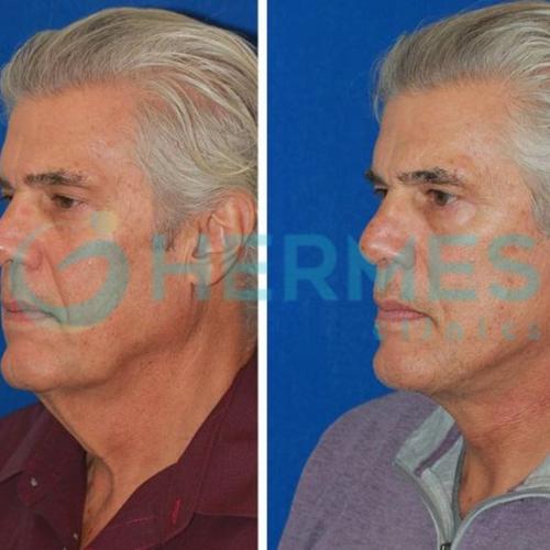 Пластическая и эстетическая хирургия Фотографии до и после